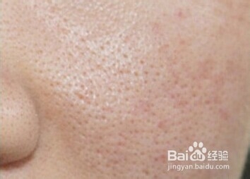 去除脸上黑头的小方法