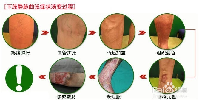 下肢静脉曲张治疗方法与注意事项