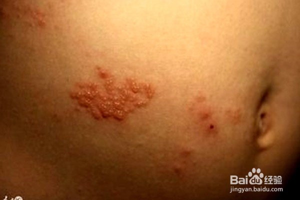 带状疱疹前期症状