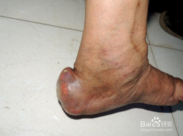 哪些食物是痛风的克星