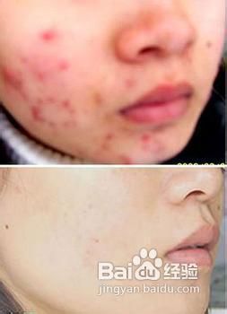 皮脂腺囊肿如何治疗