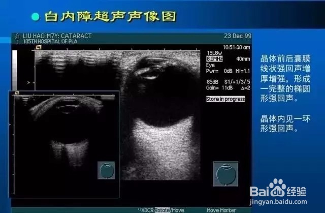 几种常见眼病B超图谱及诊断