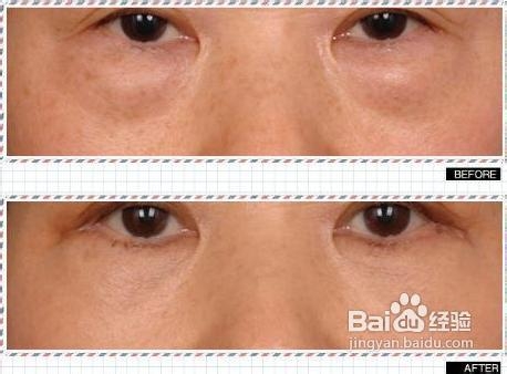 40岁女人怎样祛除大眼袋最有效？