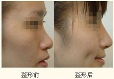 韩式隆鼻手术对蒜头鼻有没效果呢