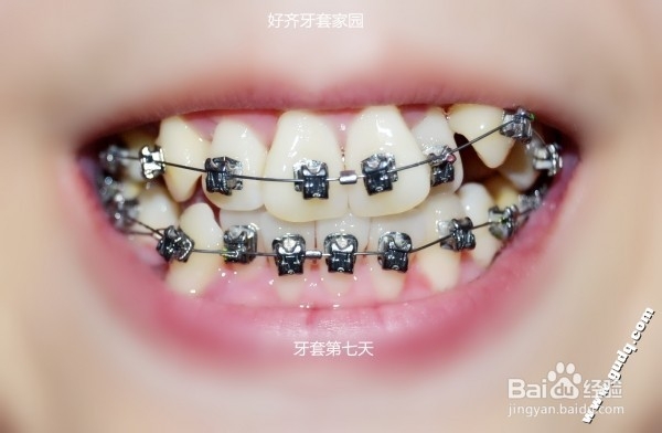<b>牙齿矫正：[5]带牙套的第七天，基本适应</b>