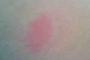 小儿蚊虫叮咬的日常护理