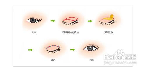 韩式整形：[7]上眼睑脂肪去除效果好吗