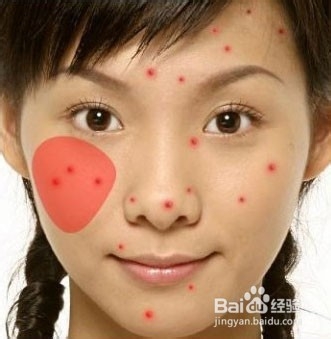 了解自己脸上的某个部位长痘痘的原因