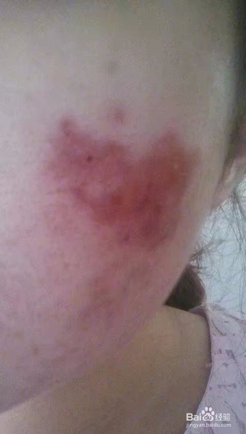 异维A酸，针清治痘痘经历