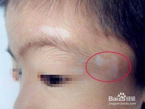 小孩蛔虫病有哪些症状，如何预防蛔虫病