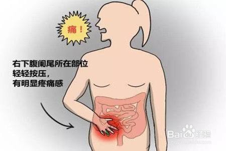 慢性阑尾炎症状有哪些