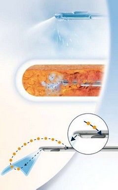 水动力吸脂对比图