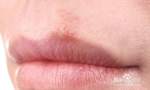 嘴唇边起泡 口唇疱疹 怎么解决 百度经验