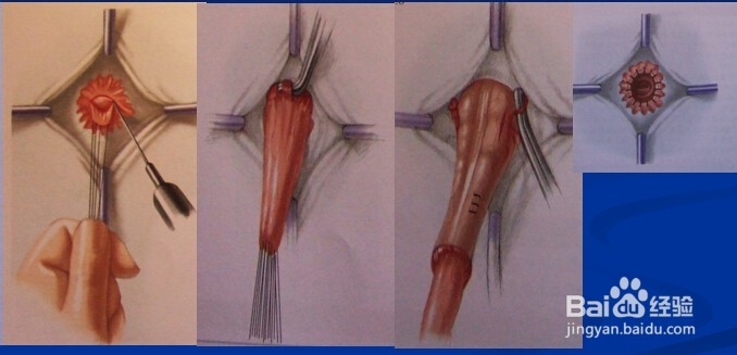 儿童常见疾病一先天性巨结肠。