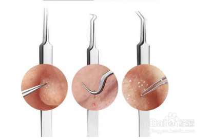双头粉刺圈使用方法