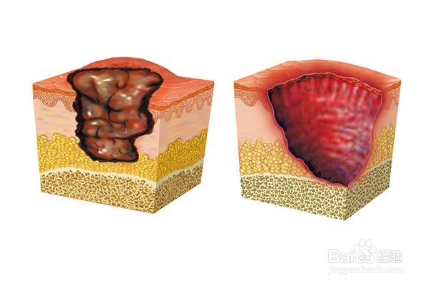 窦道型褥疮治疗最佳方法