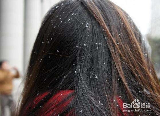 头皮屑多适合用什么洗发水呢?