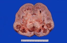 怎样预防肾结石？