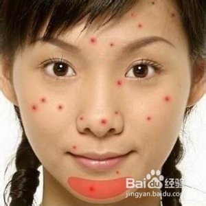 脸上长痘痘的怎么办湿气在作怪