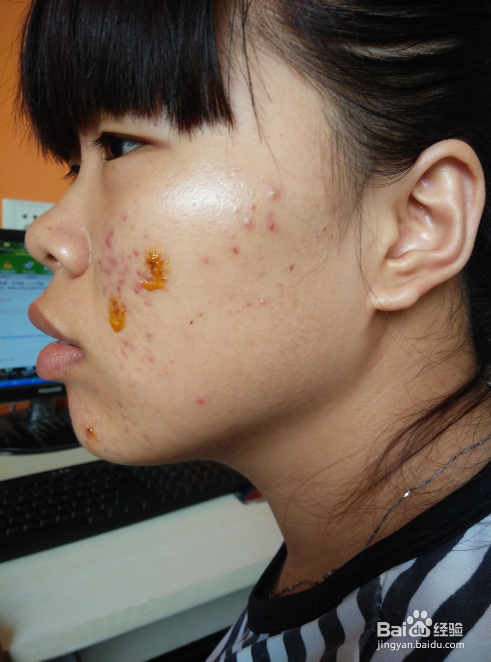 如果更好的祛痘