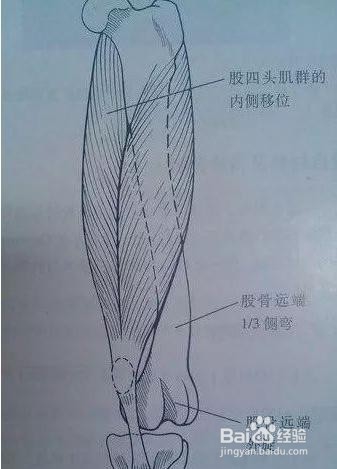 治髌骨软化症的方法