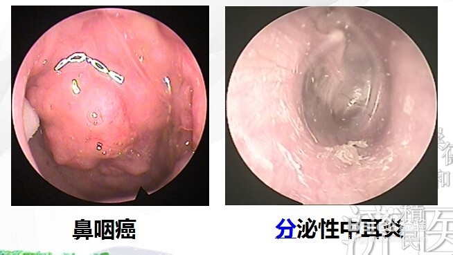 鼻咽癌淋巴结肿大图片图片