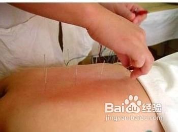 针灸减肥的方法与技巧