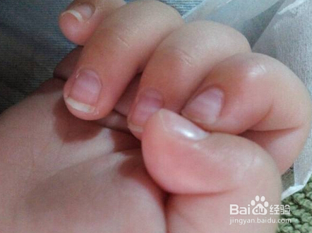 如何调理身体湿寒？湿寒重的症状