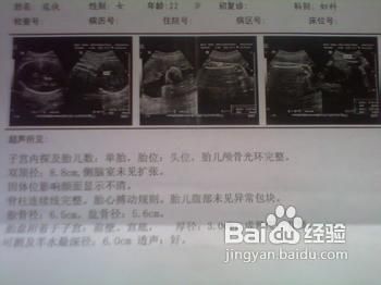 孕妇遇到怎样的情况需要剖腹产