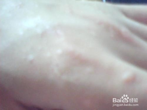 脚气怎么根治最佳