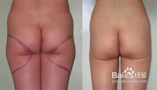 臀部吸脂好不好,臀部吸脂有什么优势
