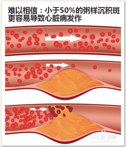 怎样预防血管堵塞,心血管堵塞有哪些症状