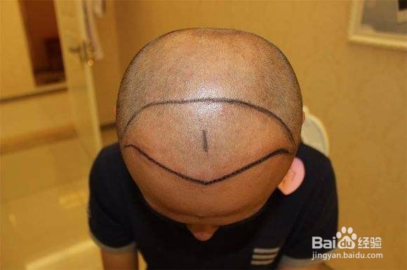 鬓角种植前怎么做不会留下疤痕