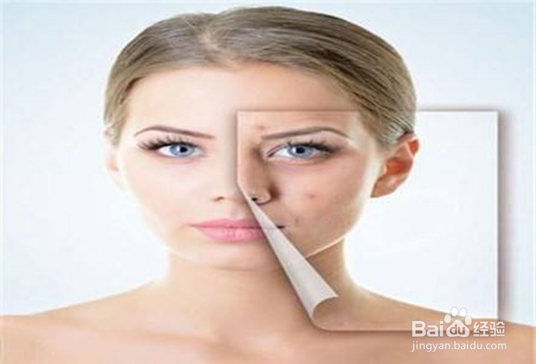 皮肤深层痘菌怎么清除