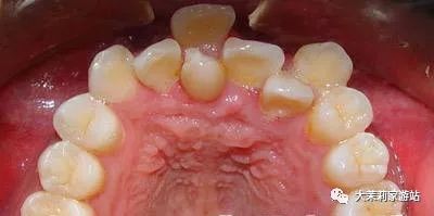 为什么牙齿需要矫正?