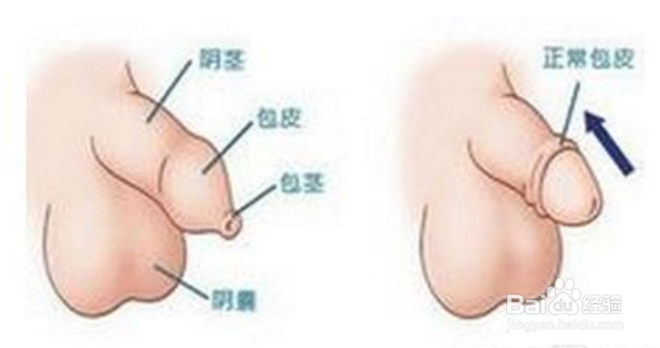 想了解小儿包茎的危害有哪些