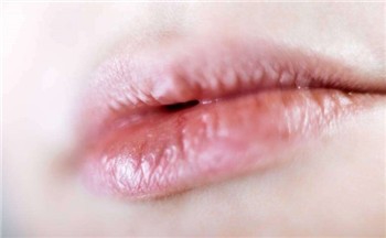 冬季嘴巴开裂怎么解决