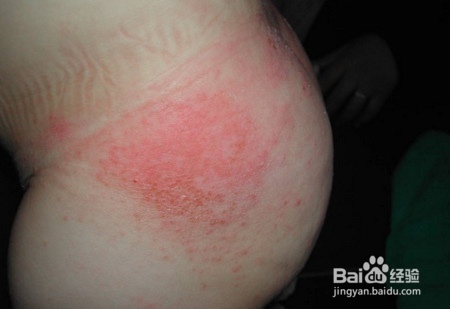 如何防治宝宝尿布疹/红屁屁