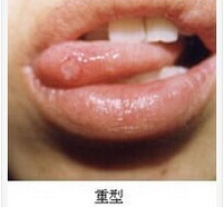 处理口腔溃疡的小方法