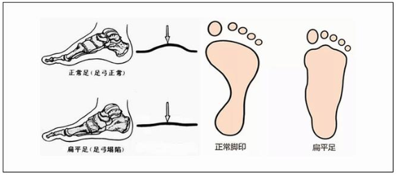 平拓足与扁平足的区别