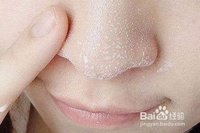 如何清除黑头、缩小毛孔和清洁皮肤呢
