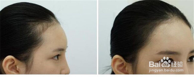 小脸神器发际线是这样做出来的