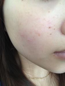 脸上的痘痘解读你健康