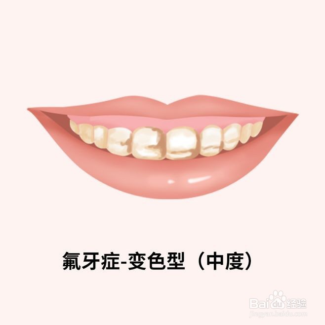 如何治疗氟牙症