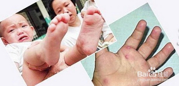 妈妈们须知，几种入夏预防手足口病的妙招