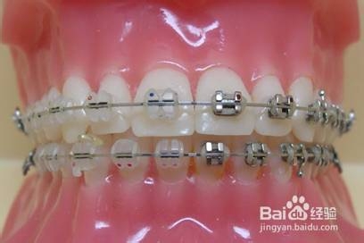 牙齿矫正的方法具体有哪几种