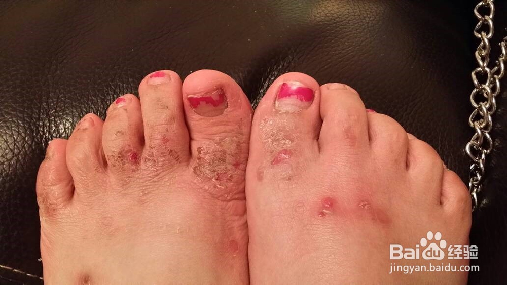生活中如何治脚气