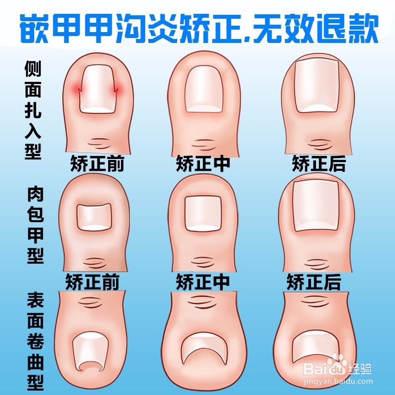 脚趾甲长进肉里了怎么办？？