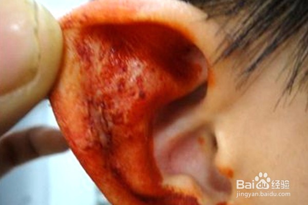 带状疱疹前期症状