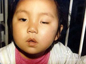 详解重症肌无力的常见症状